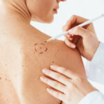 asarch blog skin cancer treatment options 1