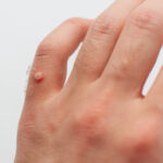 asarch blog how are warts removed 1