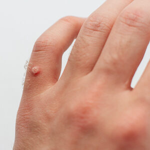 asarch blog how are warts removed